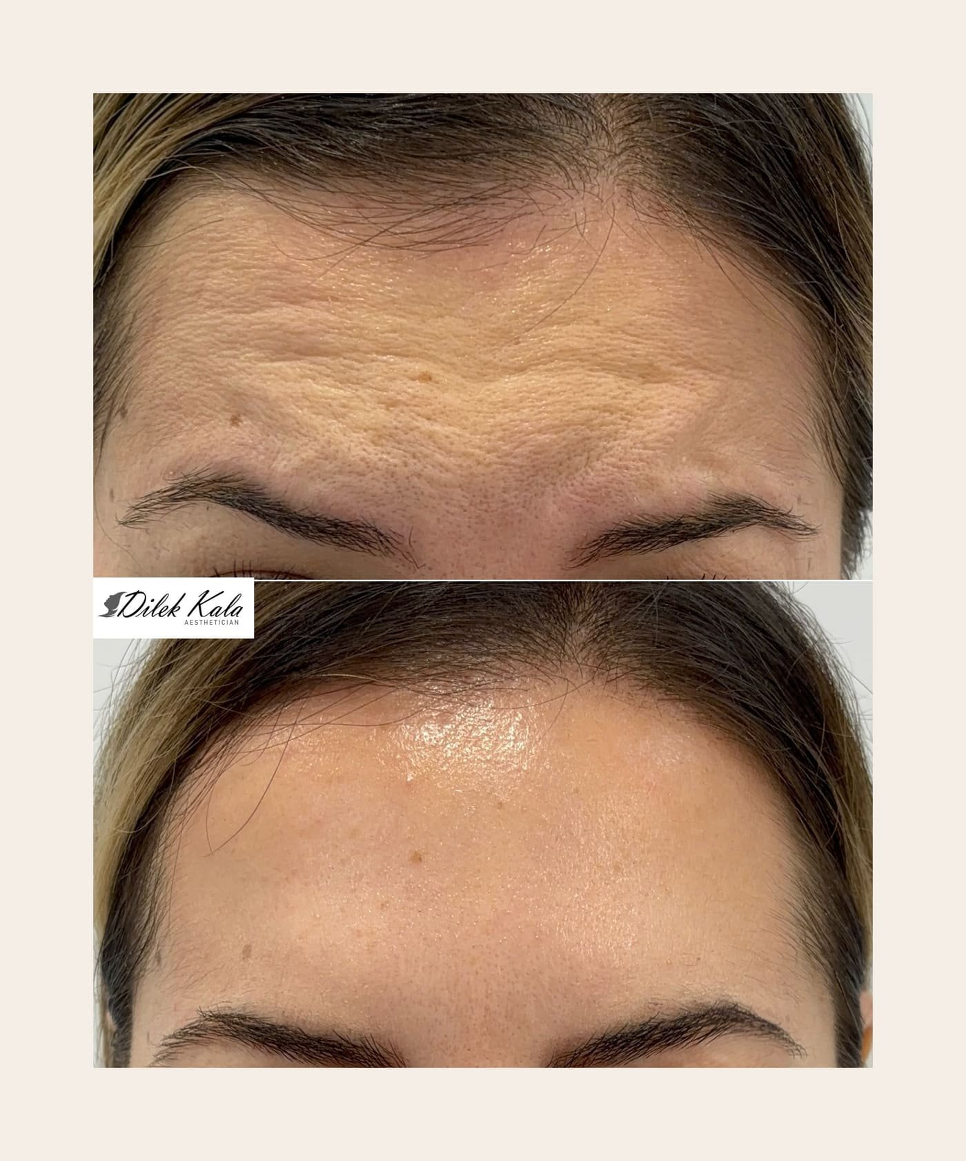 Anti-Wrinkle Treatments Explained: A Beginner's Guide