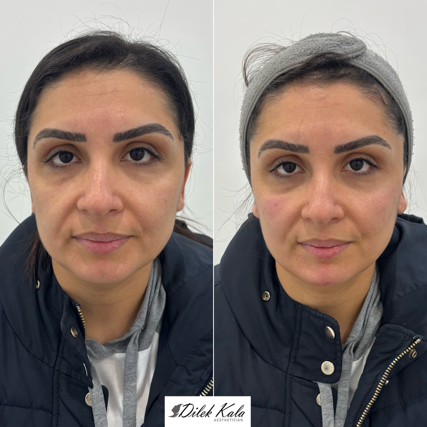 Treatment result 13