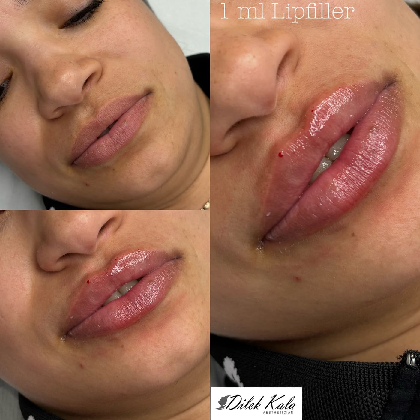 Treatment result 23