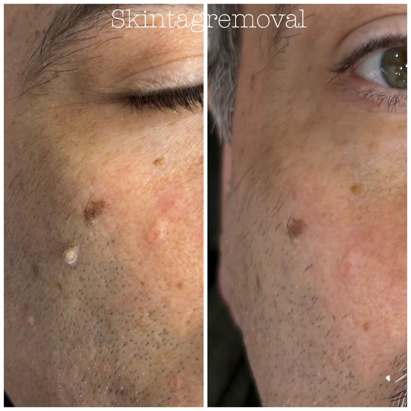 Treatment result 30