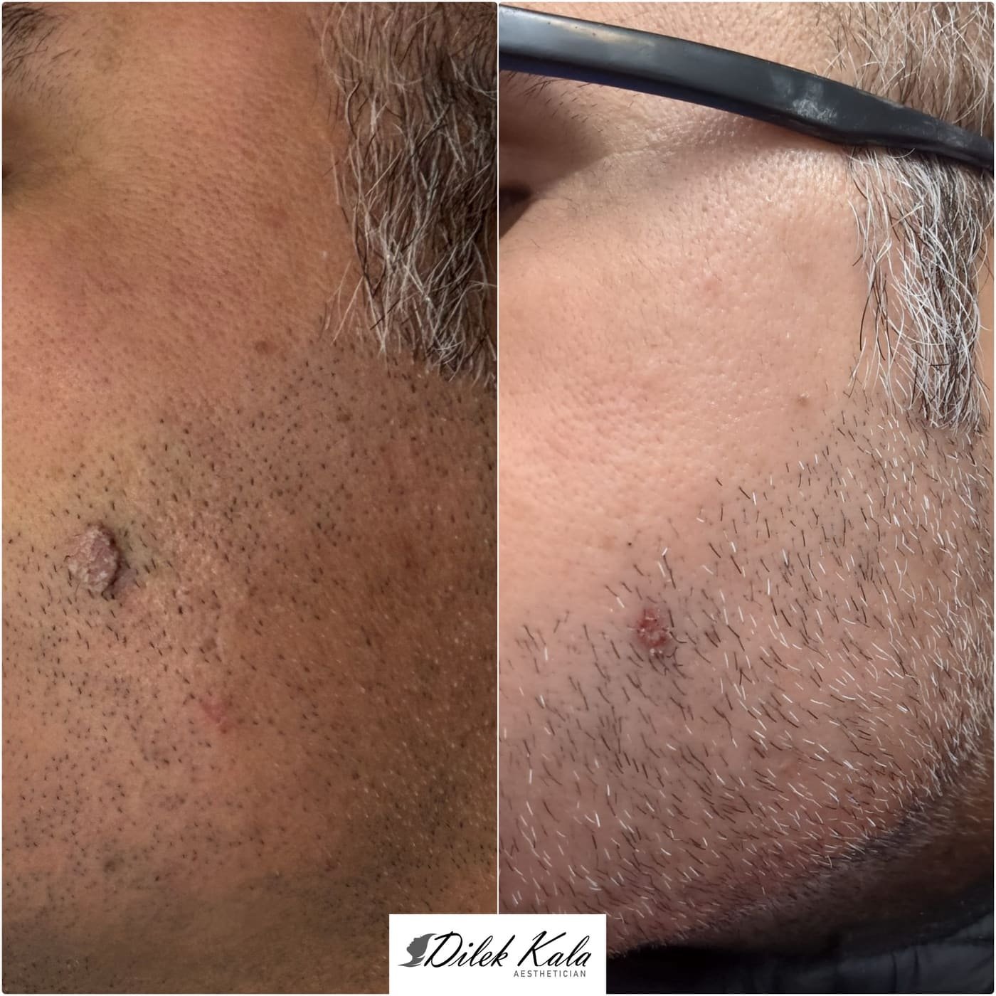 Treatment result 39