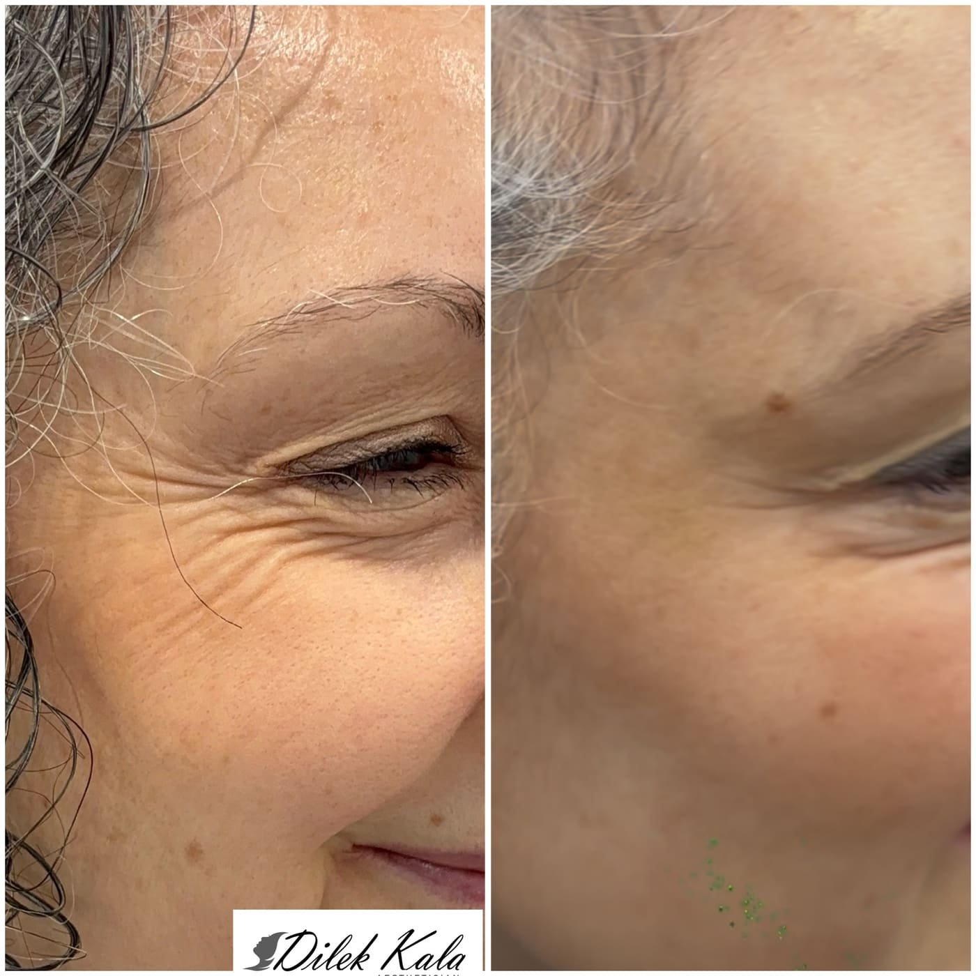 Anti-Wrinkle Treatment before and after result 1