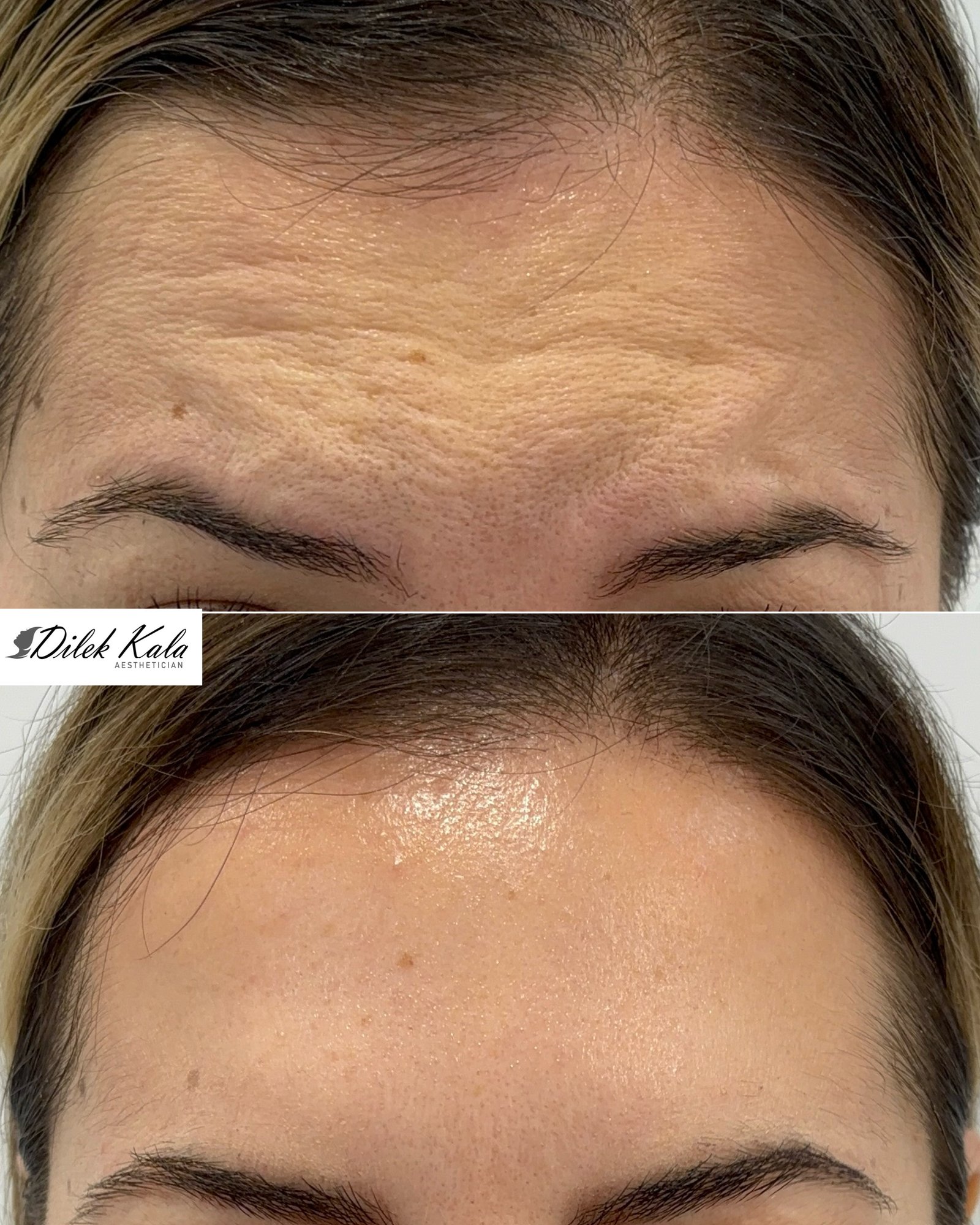 Anti-Wrinkle Treatment before and after result 3