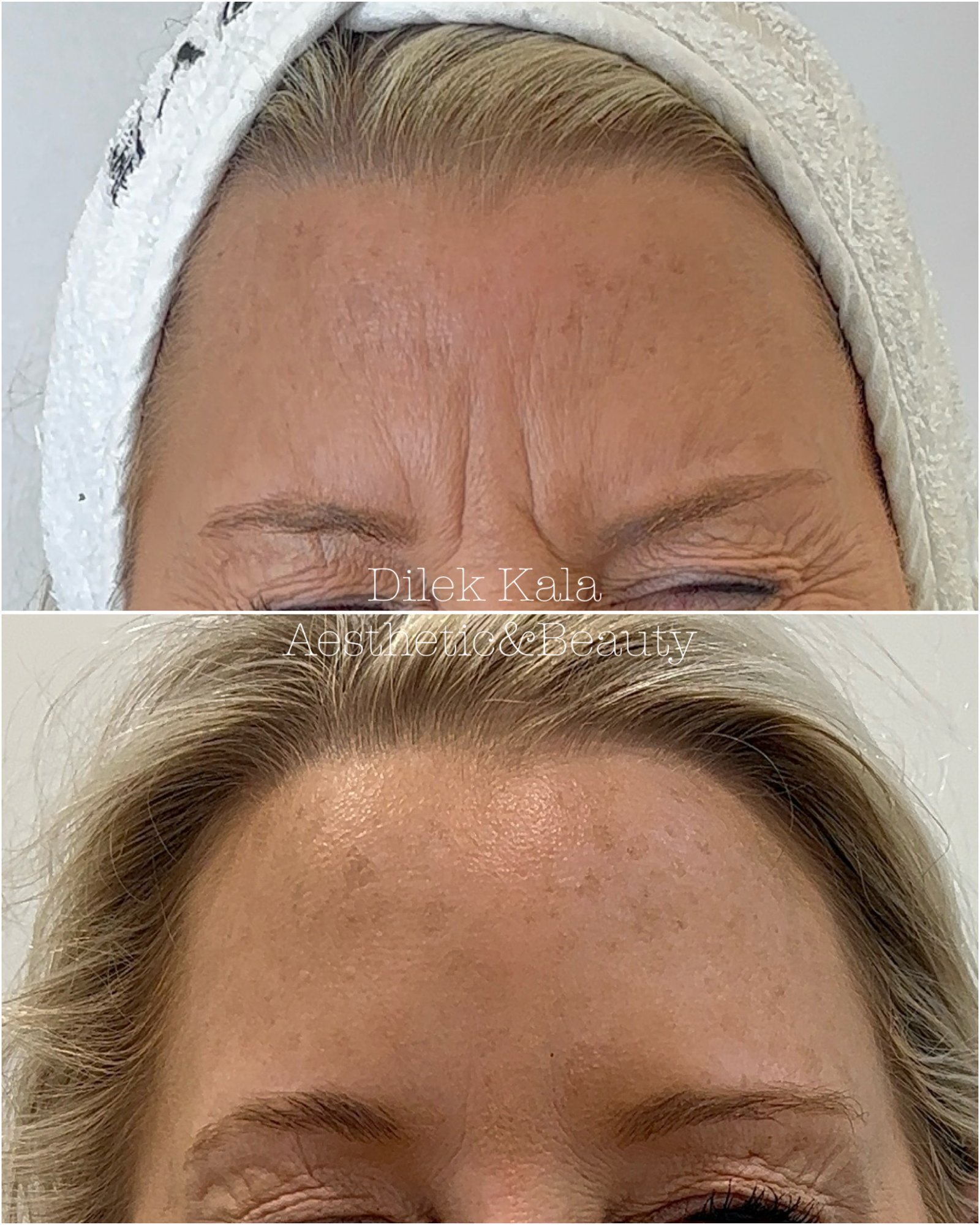 Anti-Wrinkle Treatment before and after result 4
