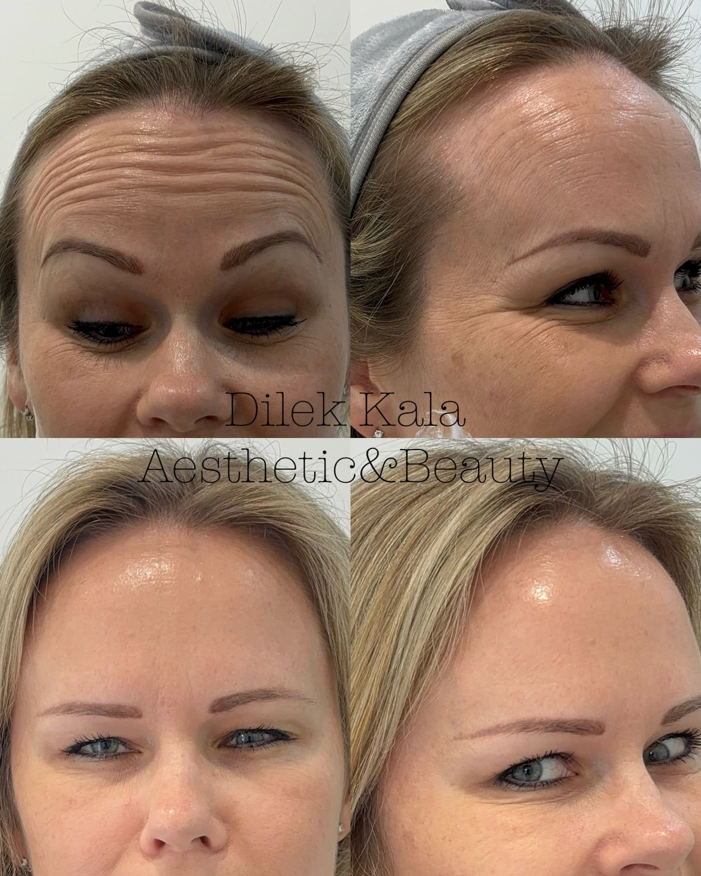 Anti-Wrinkle Treatment