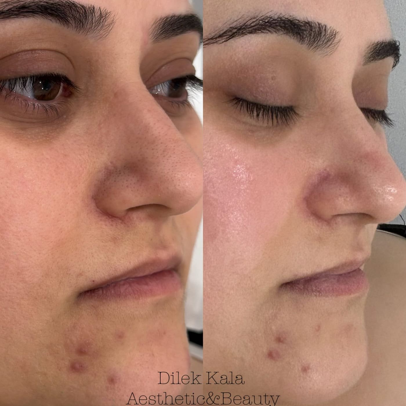 Facial Treatments before and after result 1