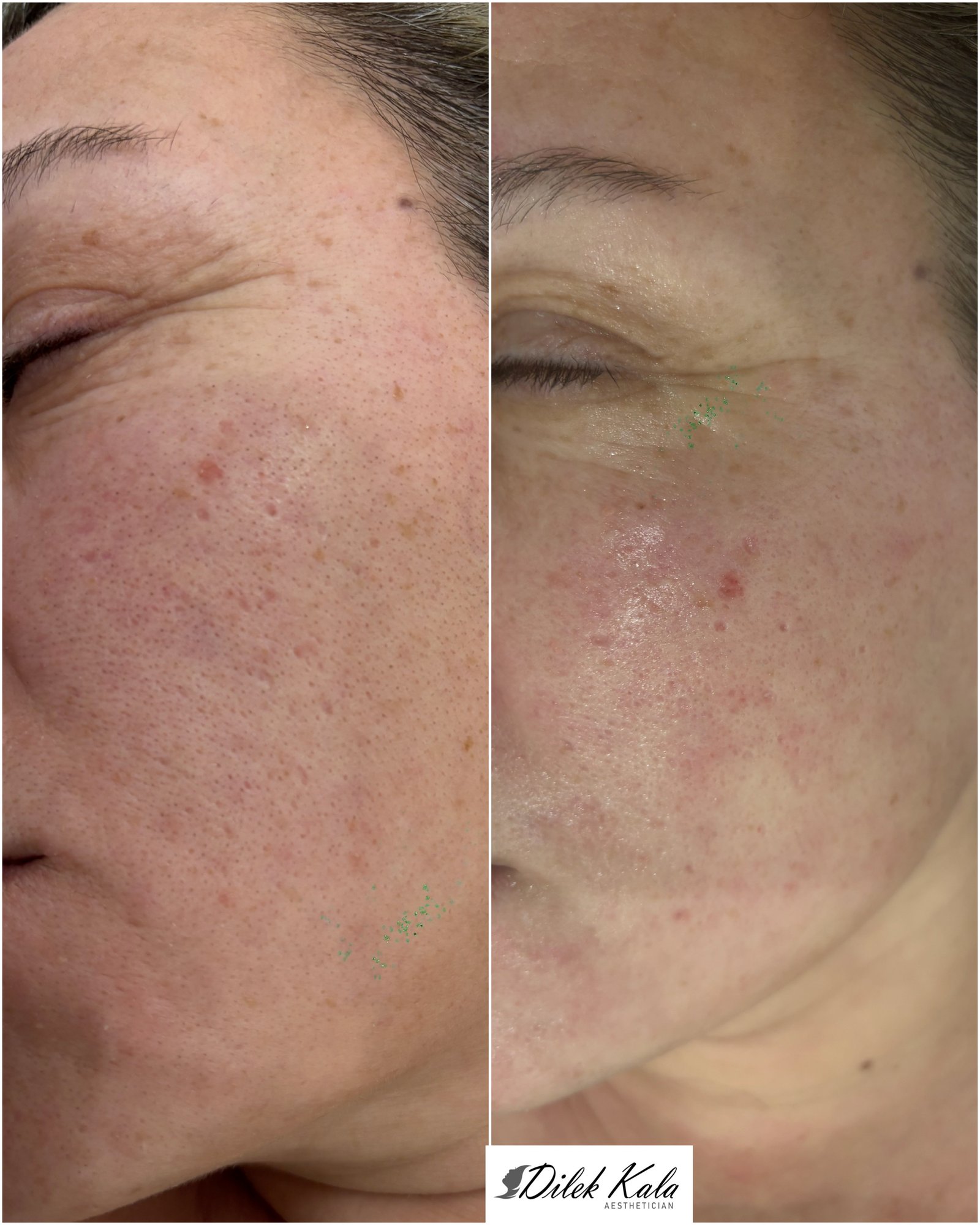 Facial Treatments before and after result 2