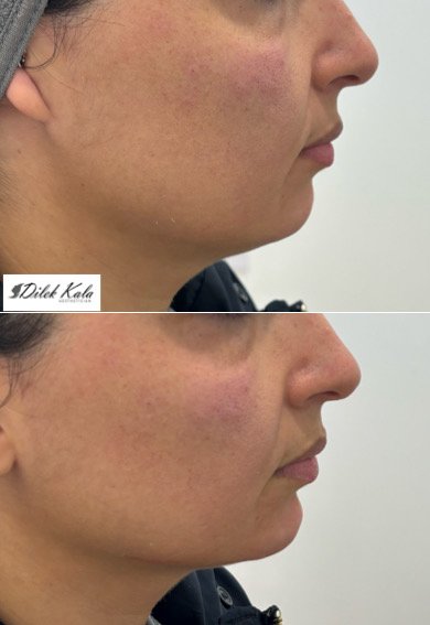 Jaw & Cheek Filler before and after result 1