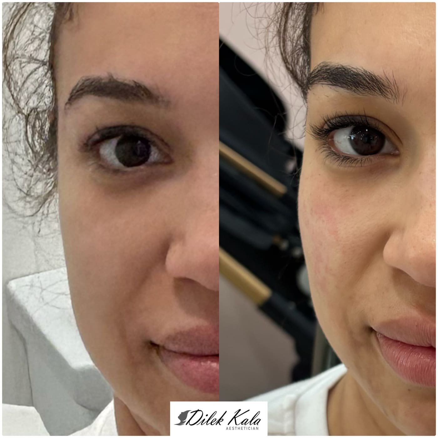 Jaw & Cheek Filler before and after result 2