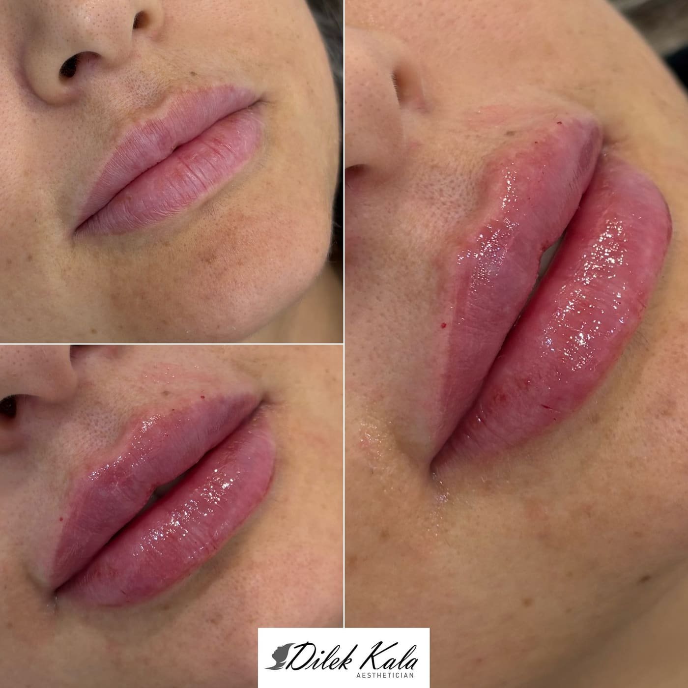 Lip Fillers before and after result 1