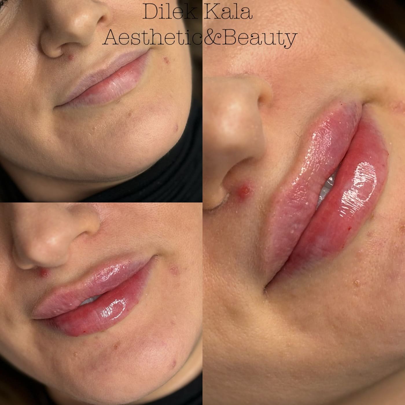 Lip Fillers before and after result 4