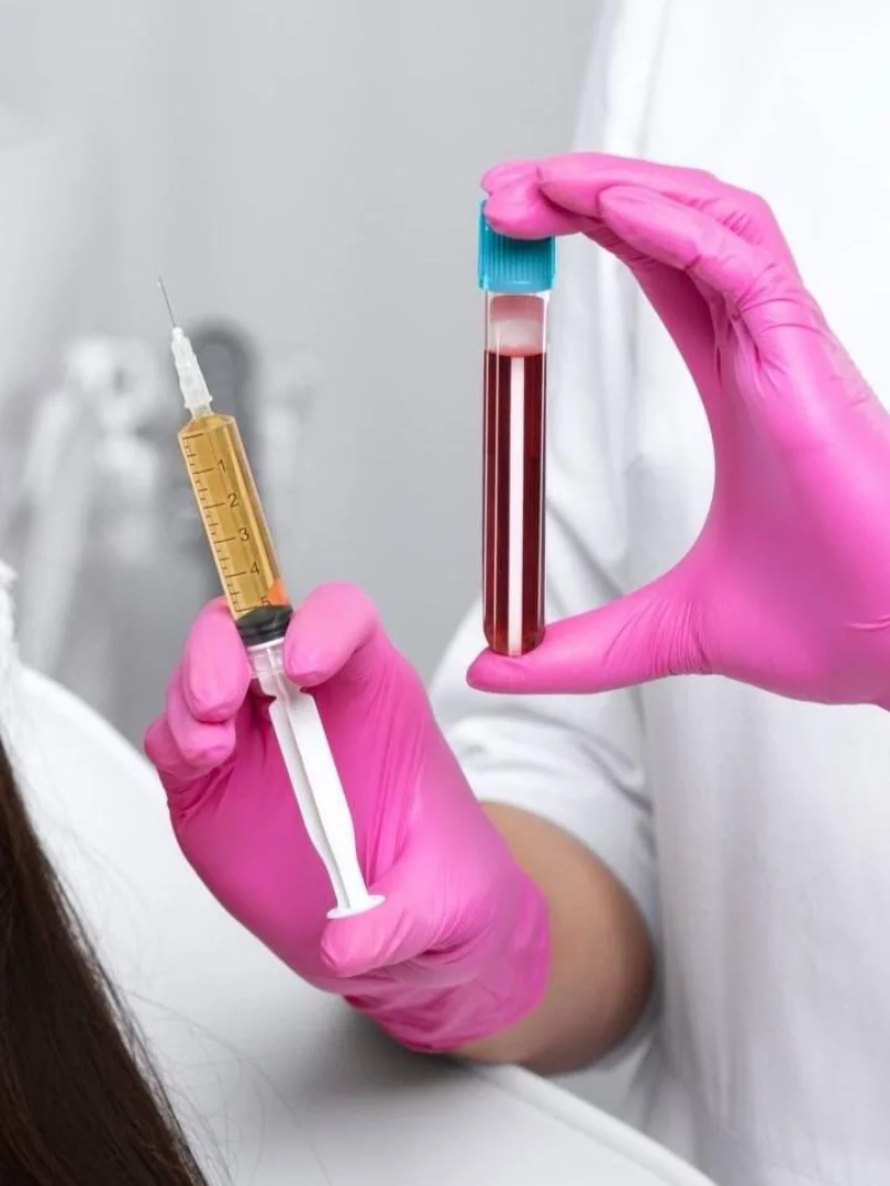 PRP Treatment