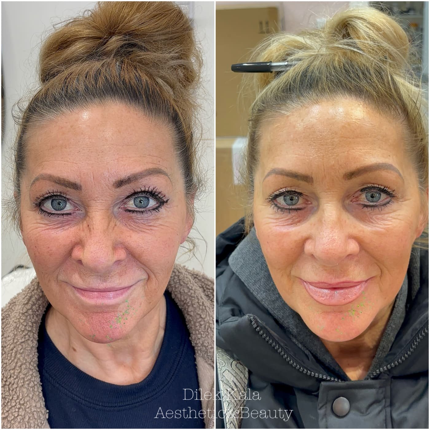Skin Boosters before and after result 1