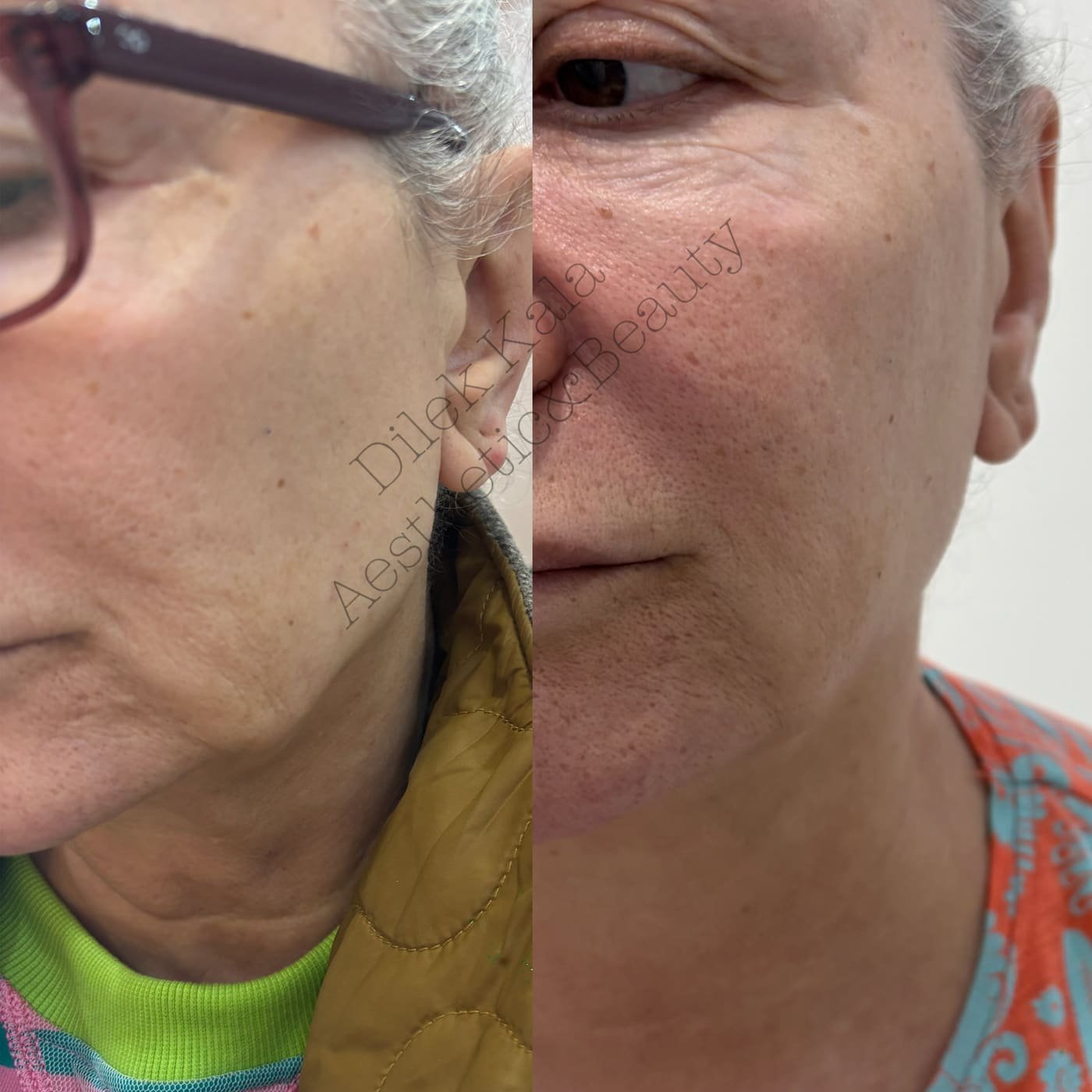 Skin Boosters before and after result 2