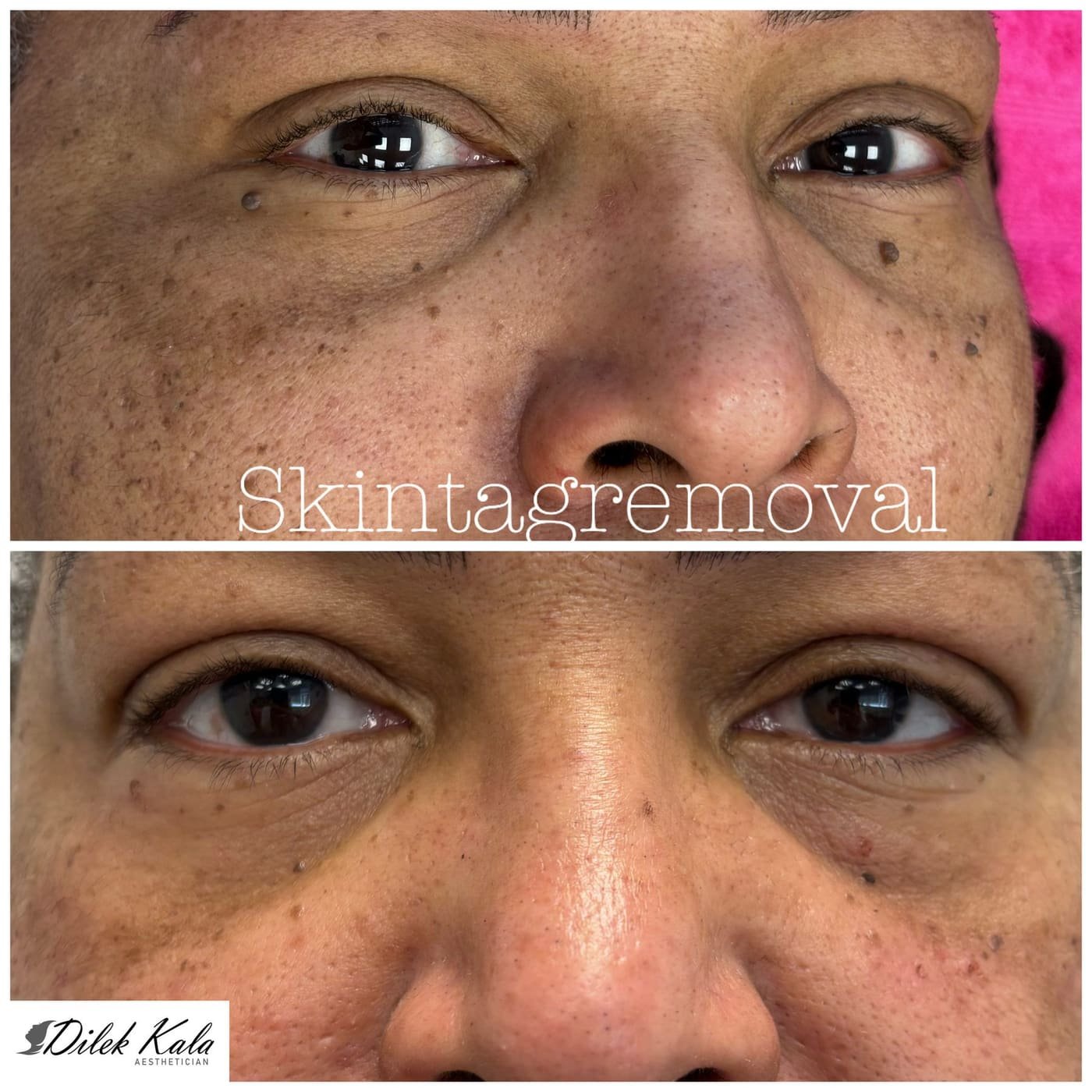 Skin Tag Removal before and after result 1