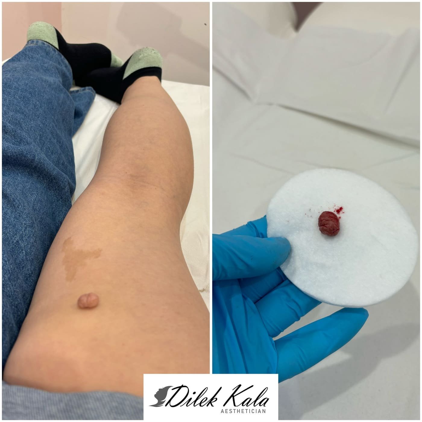 Skin Tag Removal before and after result 4