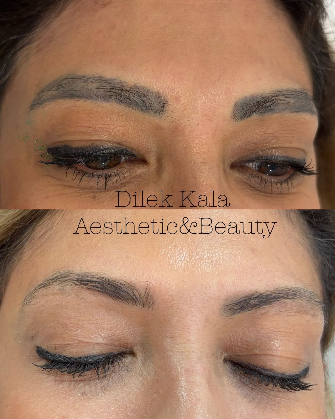 Tattoo Removal before and after result 1