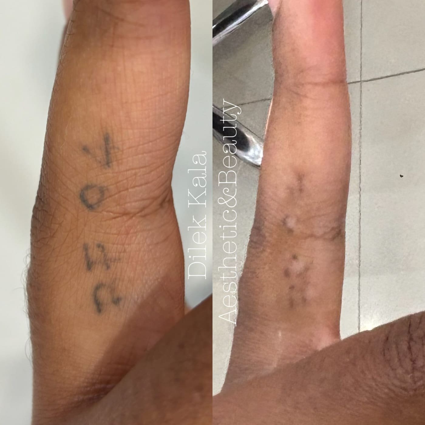 Tattoo Removal before and after result 3